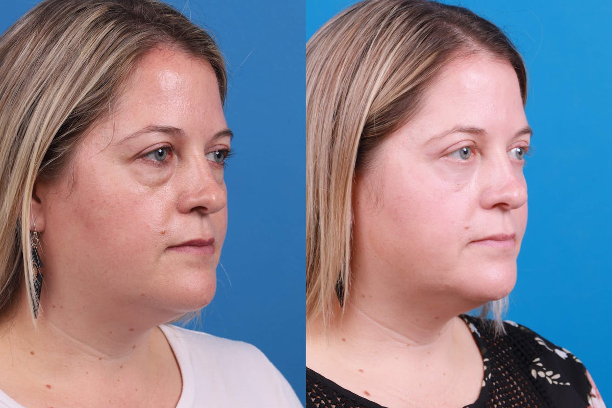 Skin Resurfacing Before & After Gallery - Patient 148734578 - Image 3