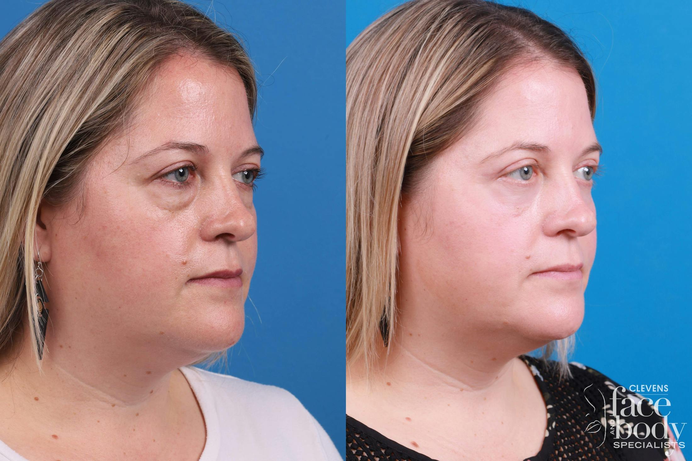 Skin Resurfacing Before & After Gallery - Patient 148734578 - Image 3