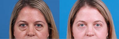 Eyelid Surgery Before & After Gallery - Patient 148734589 - Image 1