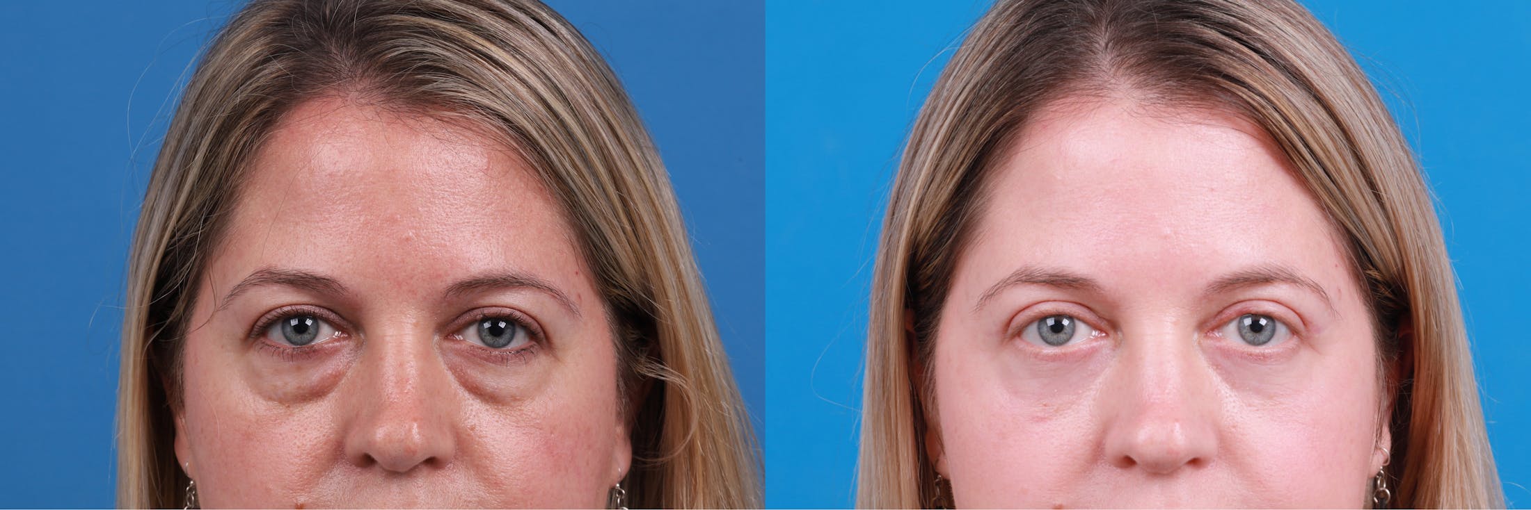 Eyelid Surgery Before & After Gallery - Patient 148734589 - Image 1