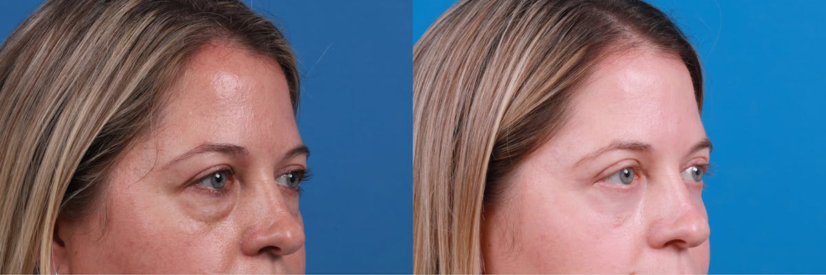 Eyelid Surgery Before & After Gallery - Patient 148734589 - Image 2
