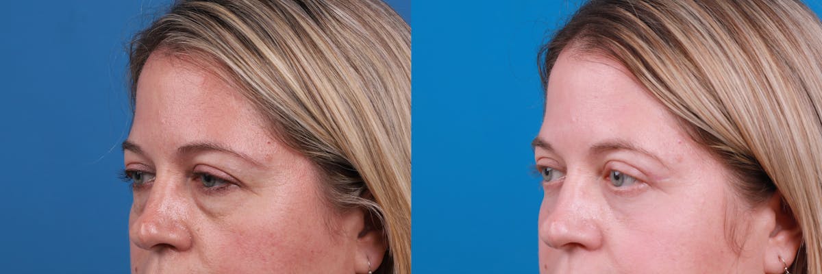 Eyelid Surgery Before & After Gallery - Patient 148734589 - Image 3