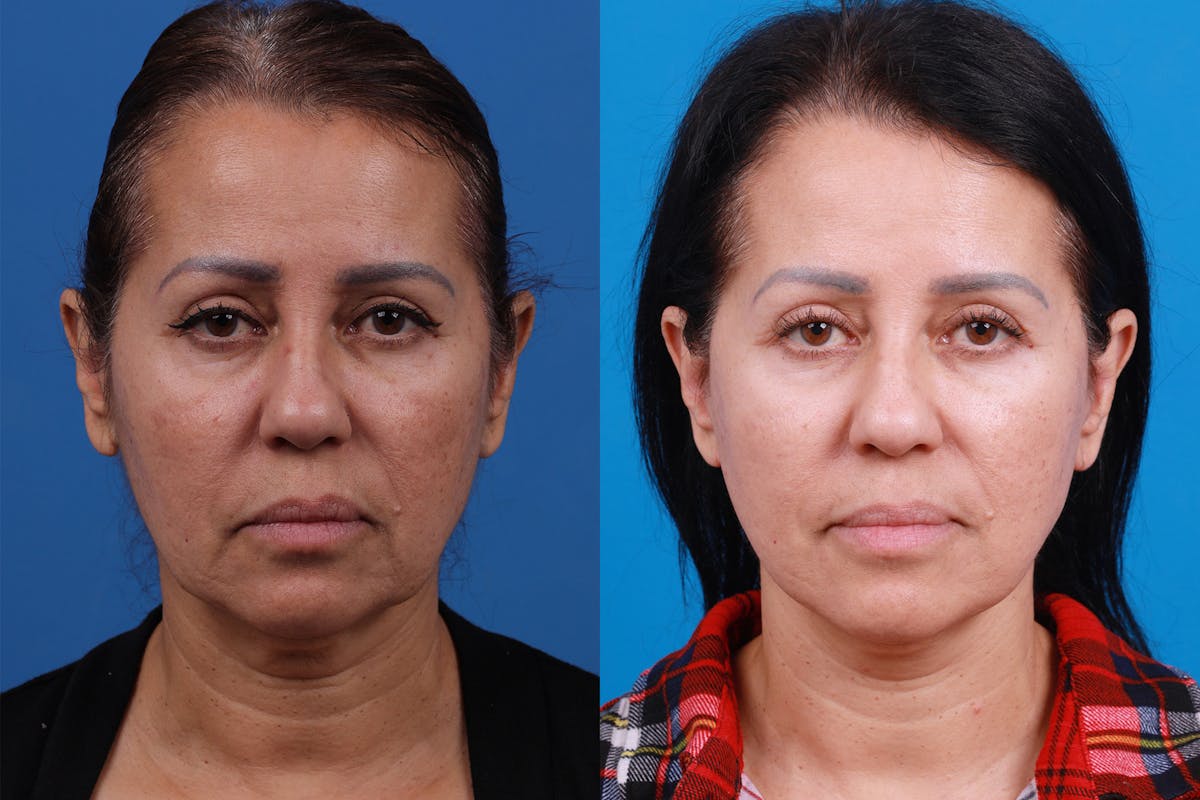 Facelift Before & After Gallery - Patient 149384769 - Image 1