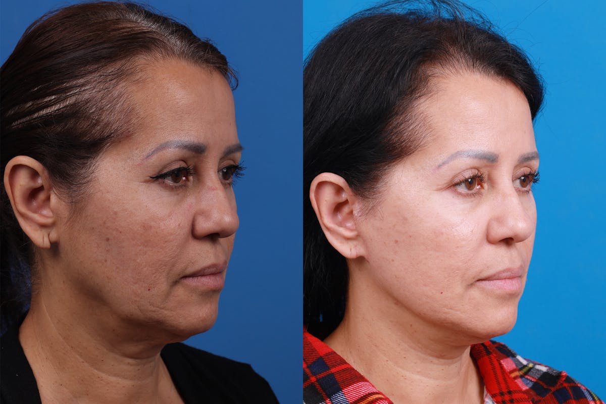 Facelift Before & After Gallery - Patient 149384769 - Image 2