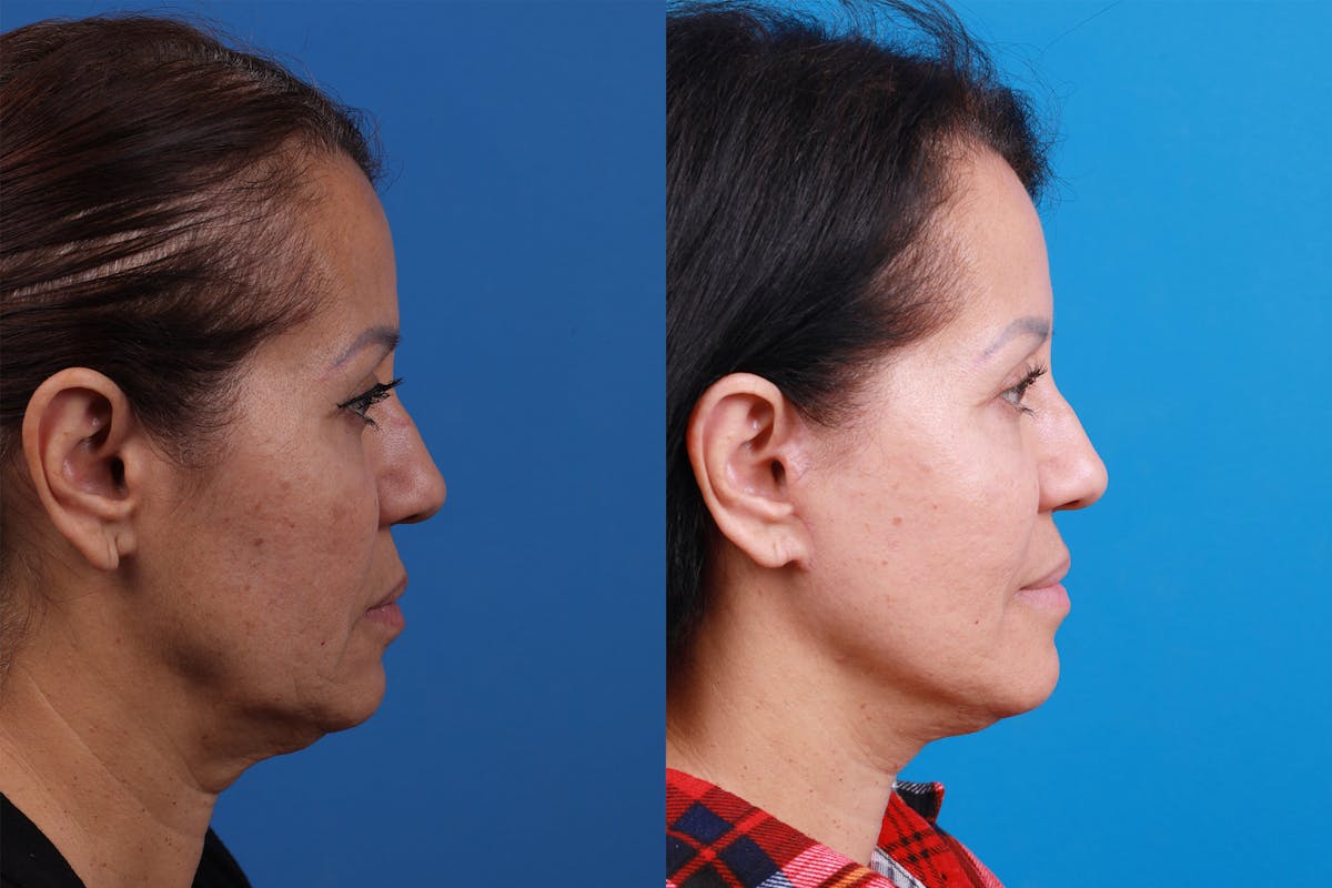 Facelift Before & After Gallery - Patient 149384769 - Image 3