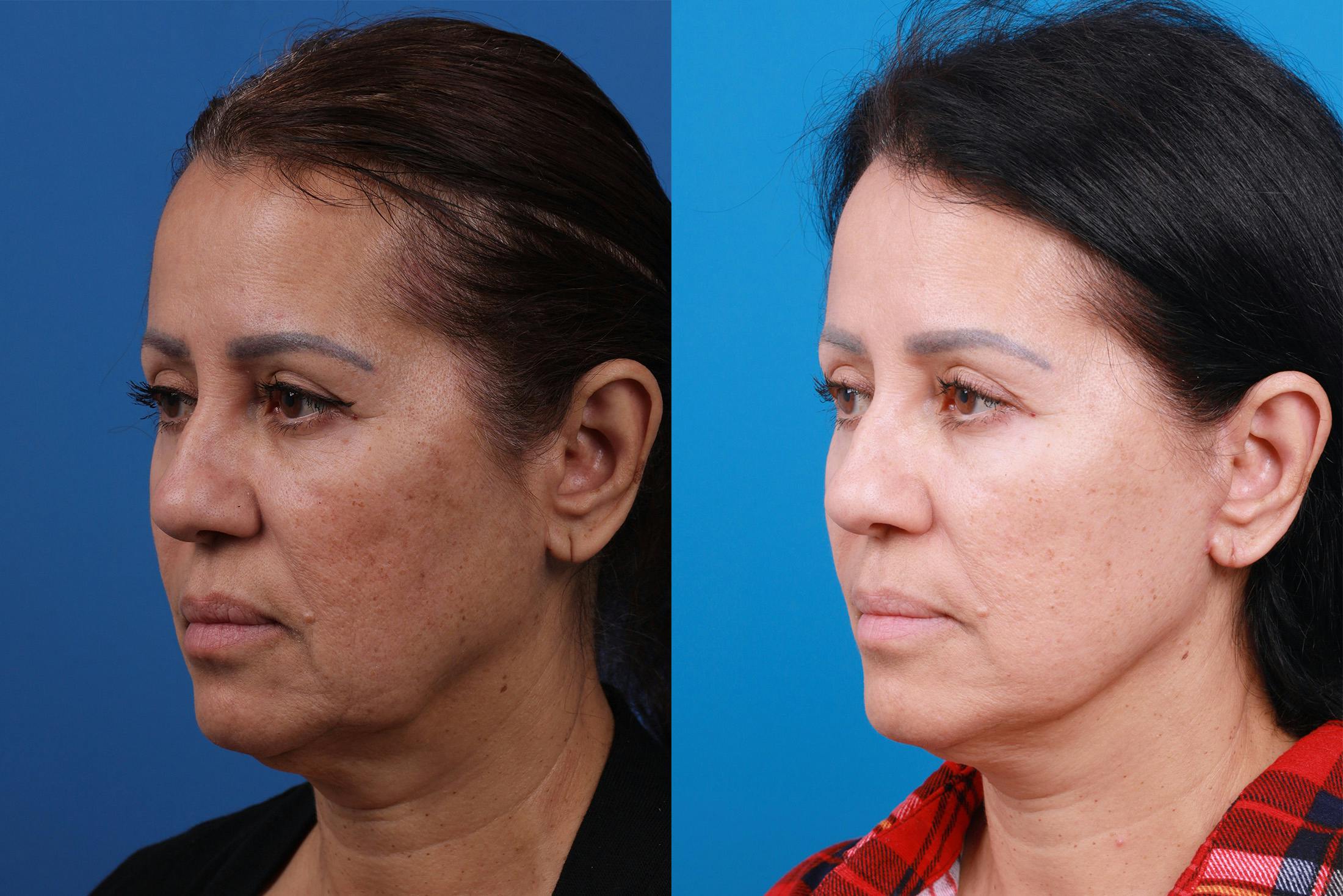 Facelift Before & After Gallery - Patient 149384769 - Image 4