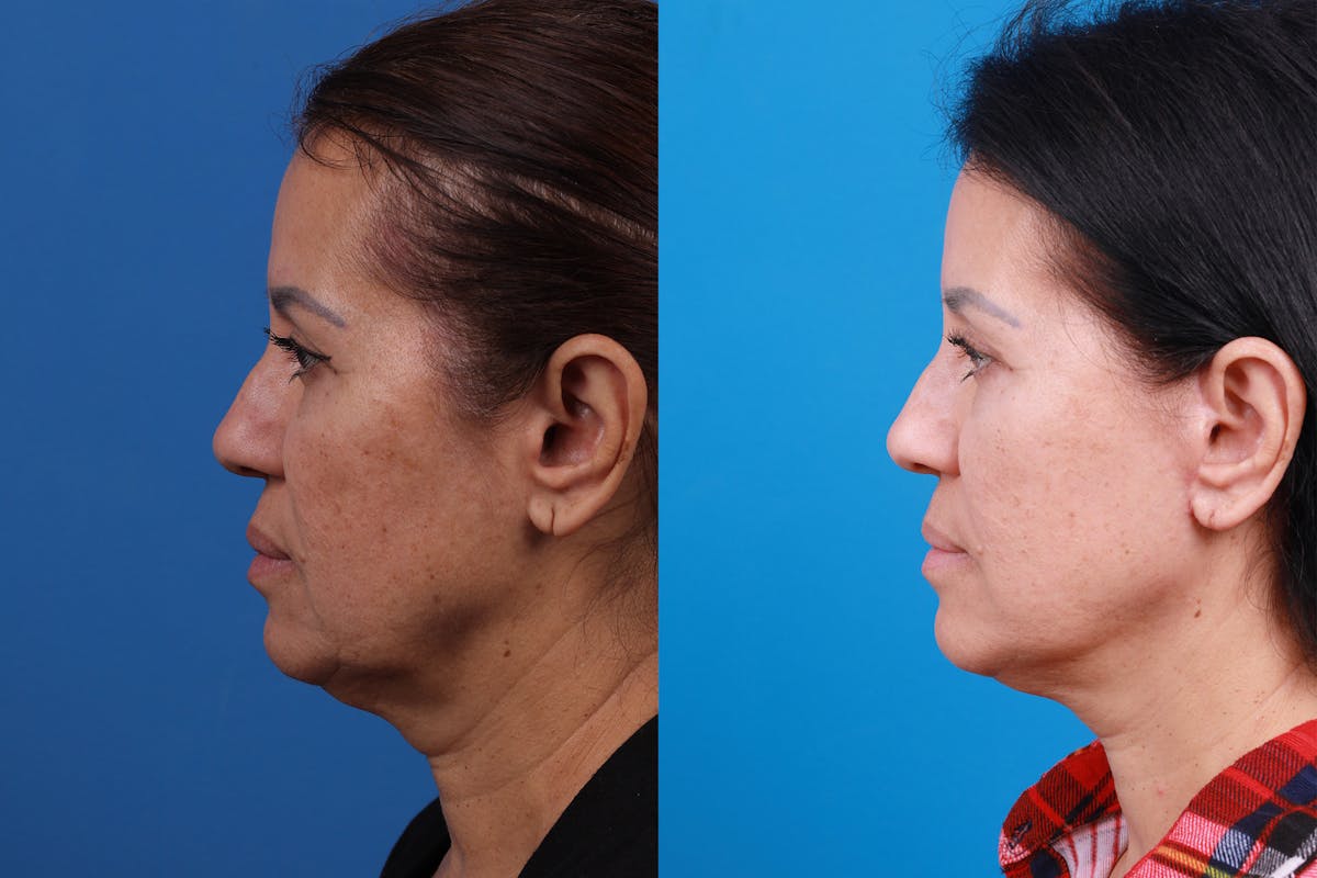 Facelift Before & After Gallery - Patient 149384769 - Image 5