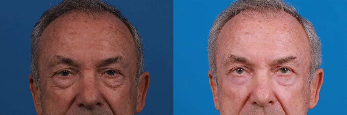 Eyelid Surgery Before & After Gallery - Patient 149384790 - Image 1