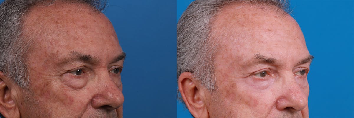 Skin Resurfacing Before & After Gallery - Patient 149385451 - Image 2