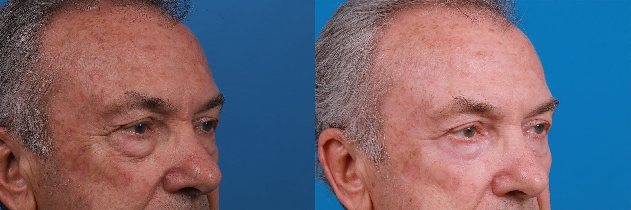 Eyelid Surgery Before & After Gallery - Patient 149384790 - Image 2