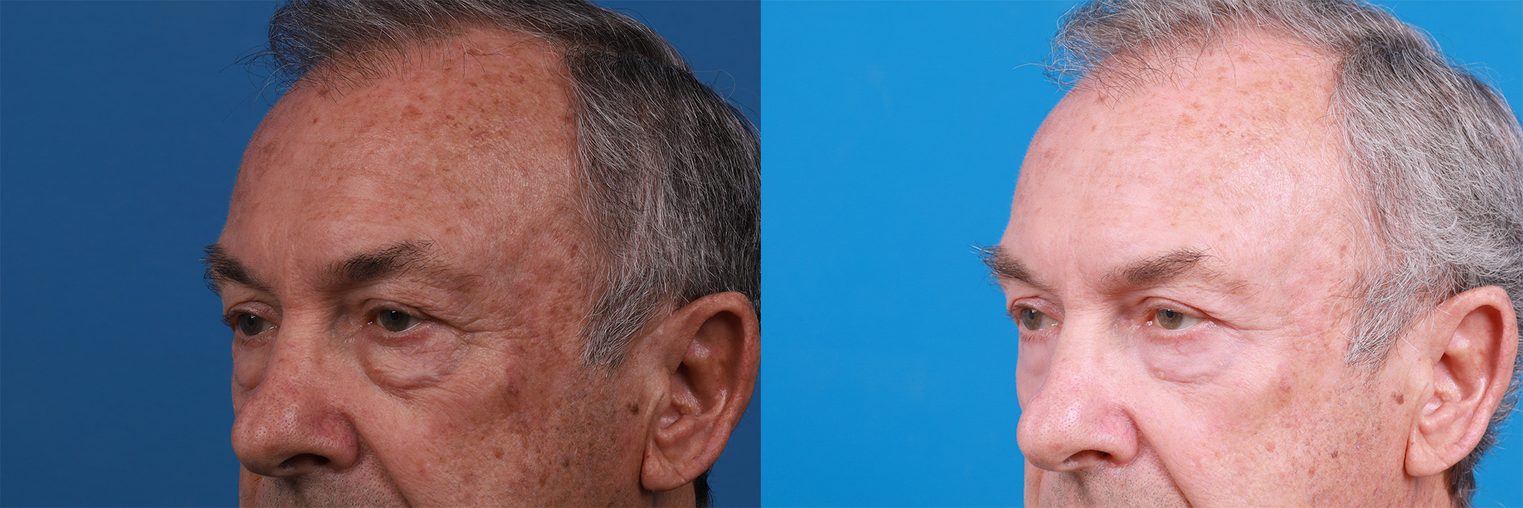 Skin Resurfacing Before & After Gallery - Patient 149385451 - Image 3