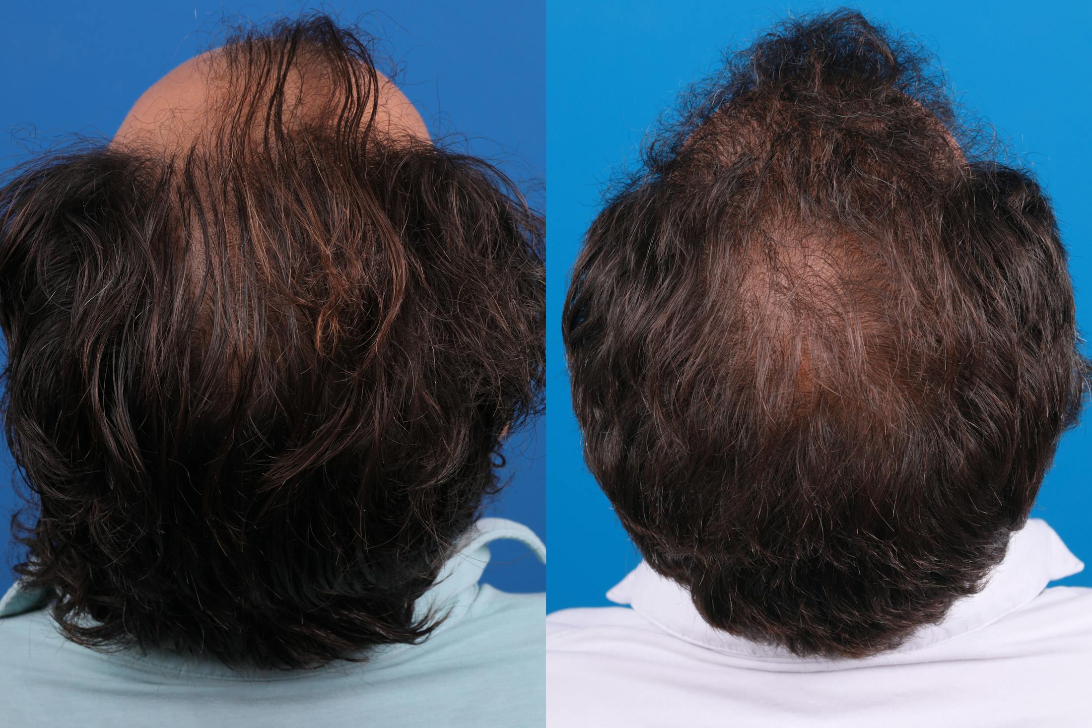 Hair Restoration Before & After Gallery - Patient 149406008 - Image 1