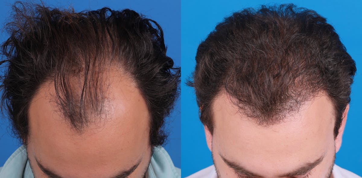 Hair Restoration Before & After Gallery - Patient 149406008 - Image 2