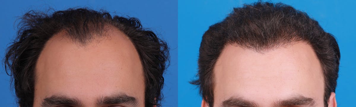 Hair Restoration Before & After Gallery - Patient 149406008 - Image 3