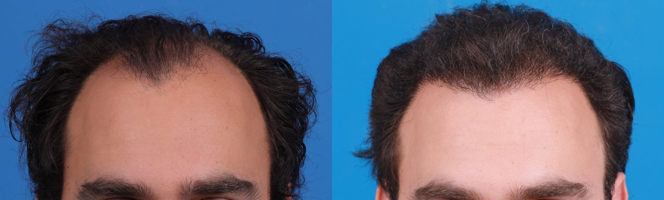 Hair Restoration Before & After Gallery - Patient 149406008 - Image 3