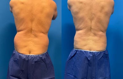 CoolSculpting ELITE results at Clevens Face & Body Specialists in Florida