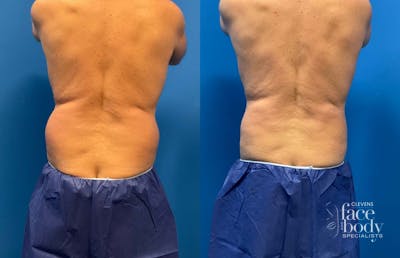 CoolSculpting ELITE results at Clevens Face & Body Specialists in Florida