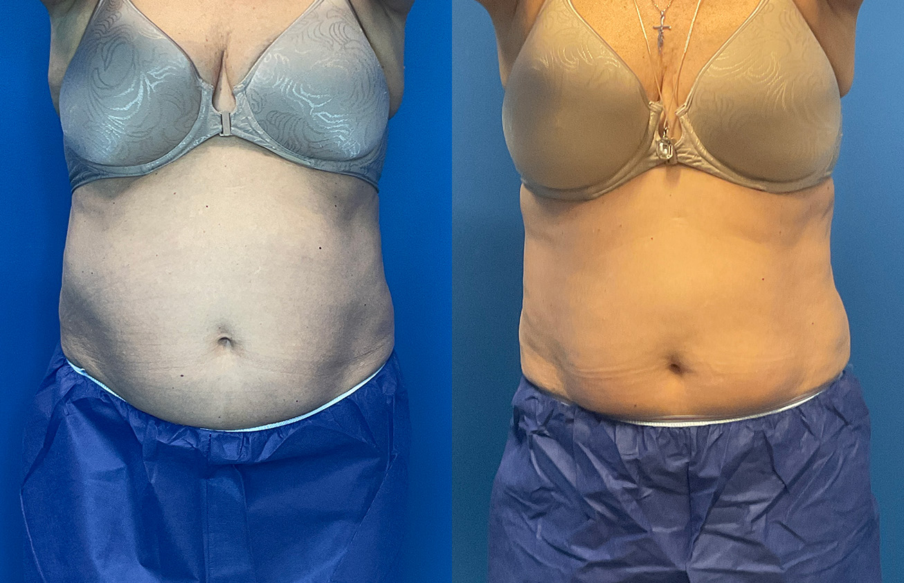 CoolSculpting Before & After Gallery - Patient 186870 - Image 1