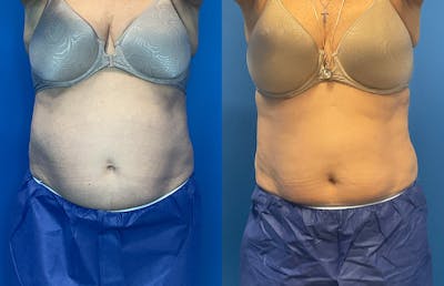 CoolSculpting Before & After Gallery - Patient 149463932 - Image 1