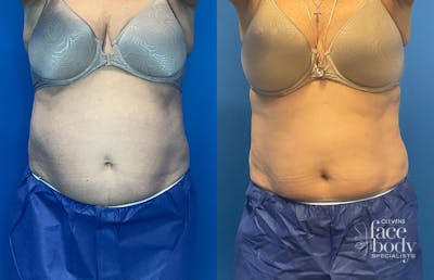 CoolSculpting Before & After Gallery - Patient 186870 - Image 1