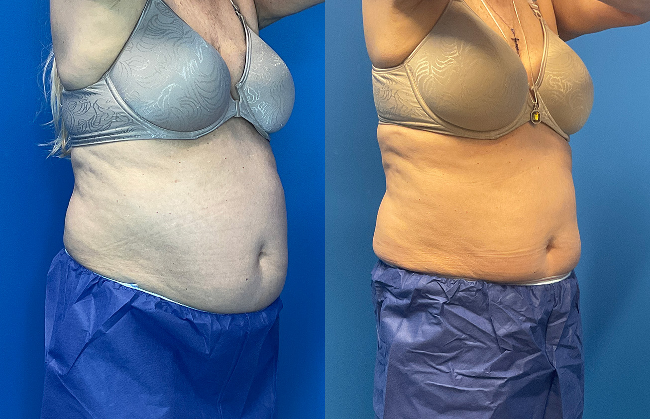 CoolSculpting Before & After Gallery - Patient 186870 - Image 2
