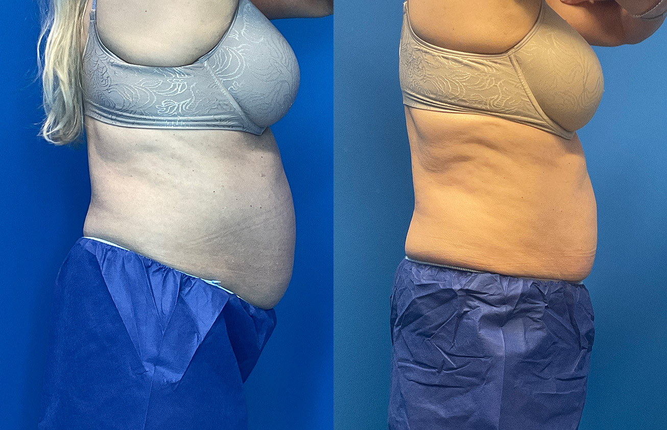CoolSculpting Before & After Gallery - Patient 186870 - Image 3