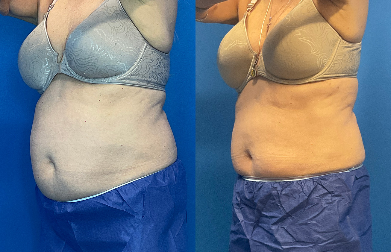 CoolSculpting Before & After Gallery - Patient 186870 - Image 4