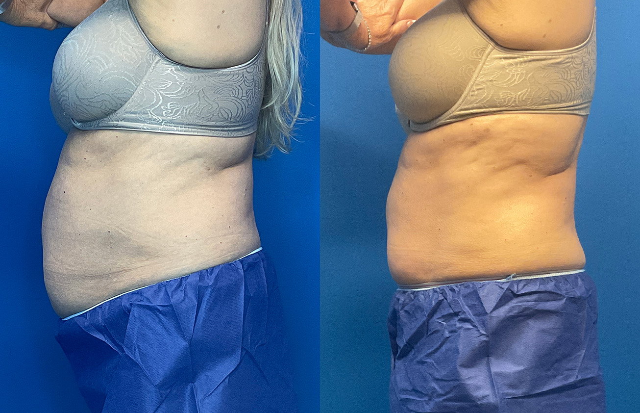 CoolSculpting Before & After Gallery - Patient 186870 - Image 5