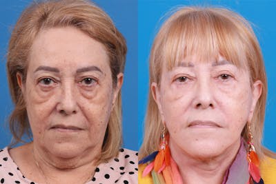 Facelift Before & After Gallery - Patient 149464005 - Image 1