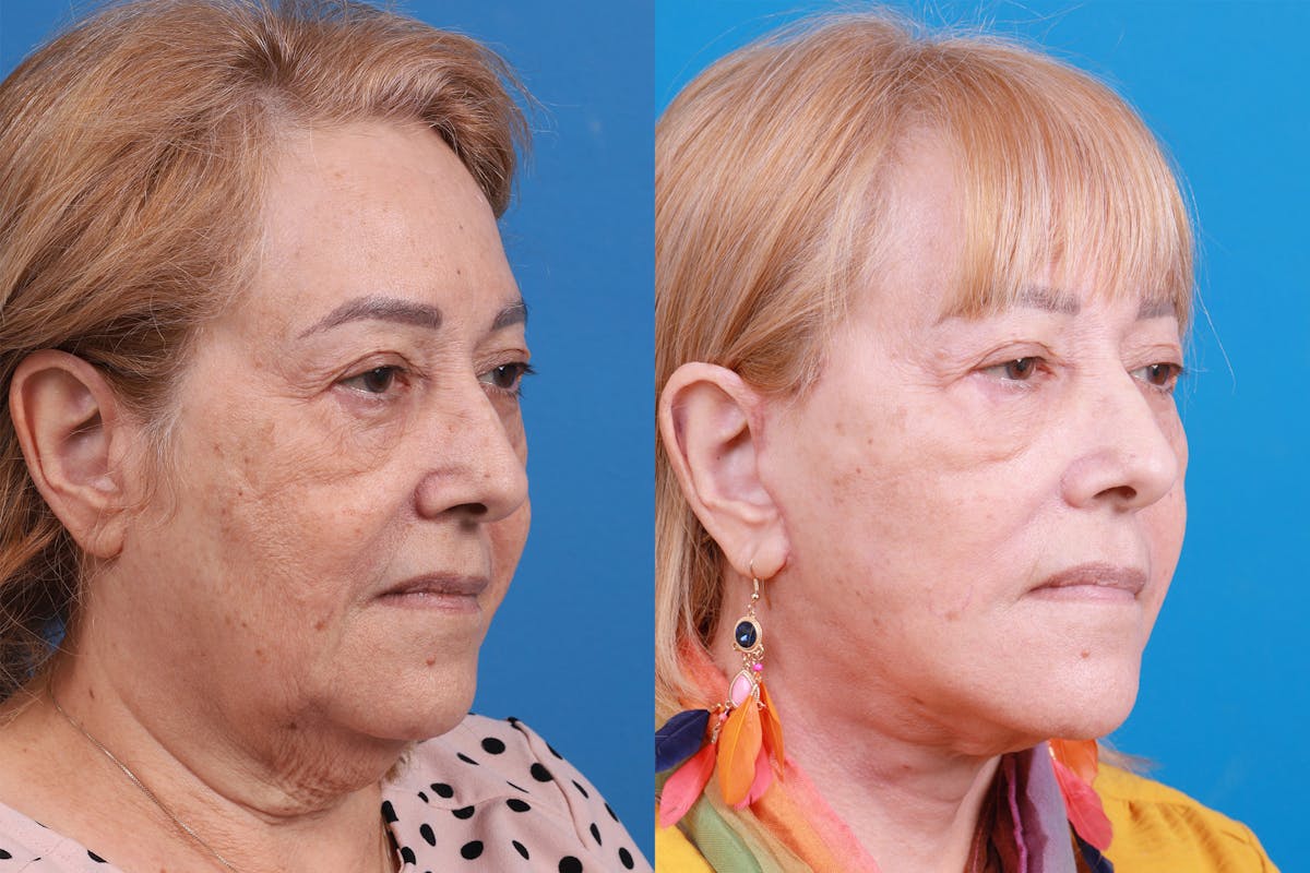 Facelift Before & After Gallery - Patient 149464005 - Image 2