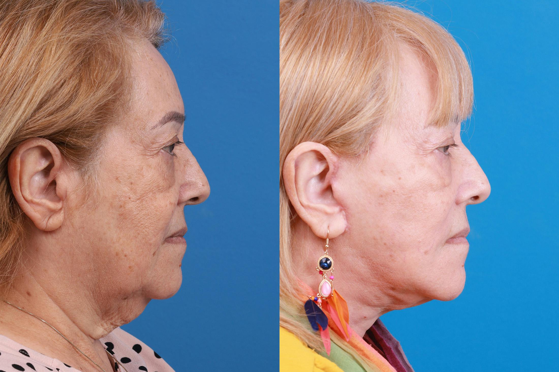 Facelift Before & After Gallery - Patient 149464005 - Image 3