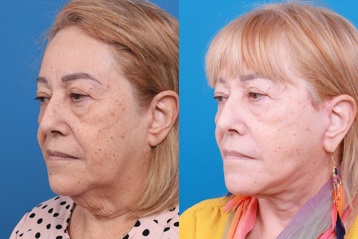 Facelift Before & After Gallery - Patient 149464005 - Image 4