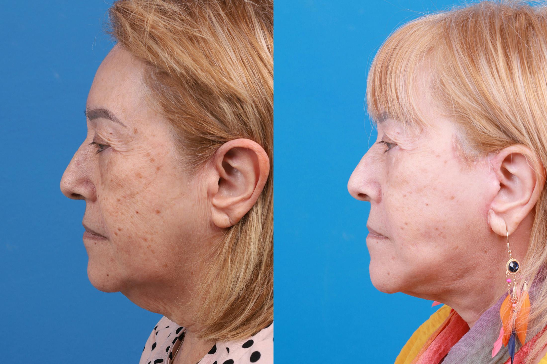 Facelift Before & After Gallery - Patient 149464005 - Image 5