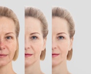 Ozempic Face How Rapid Weight Loss Affects Facial Skin Blog 