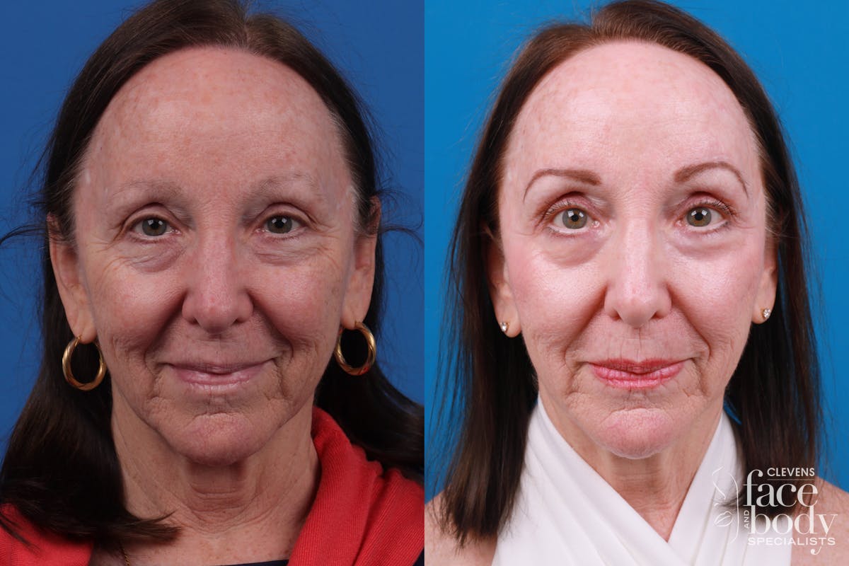 Skin Resurfacing Before & After Gallery - Patient 150490829 - Image 1