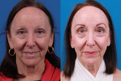 Eyelid Surgery Before & After Gallery - Patient 150490828 - Image 1