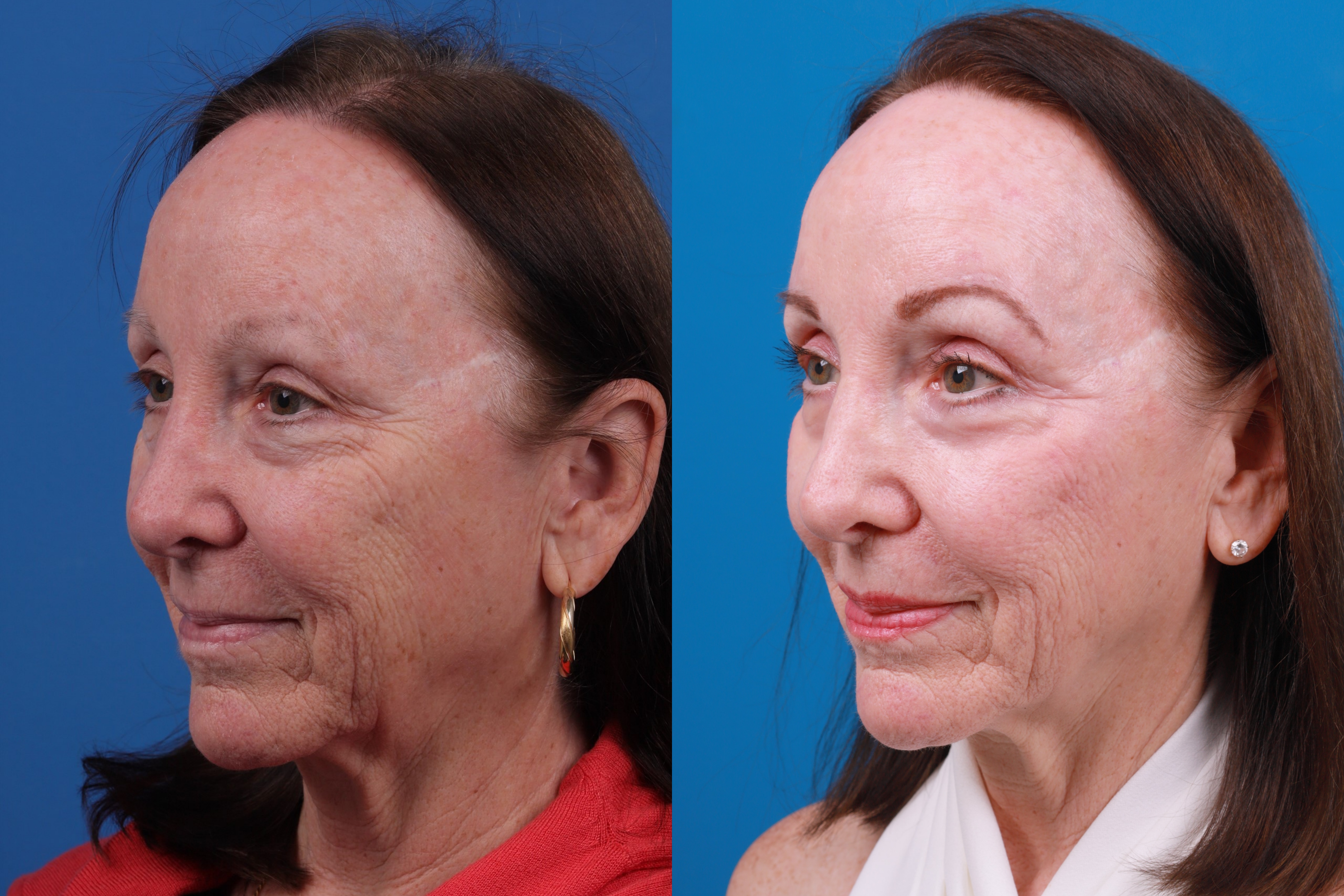 Brow Lift Before & After Gallery - Patient 150490826 - Image 2