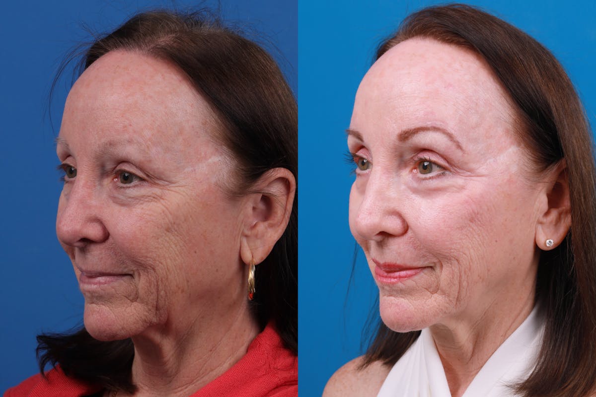 Eyelid Surgery Before & After Gallery - Patient 150490828 - Image 2