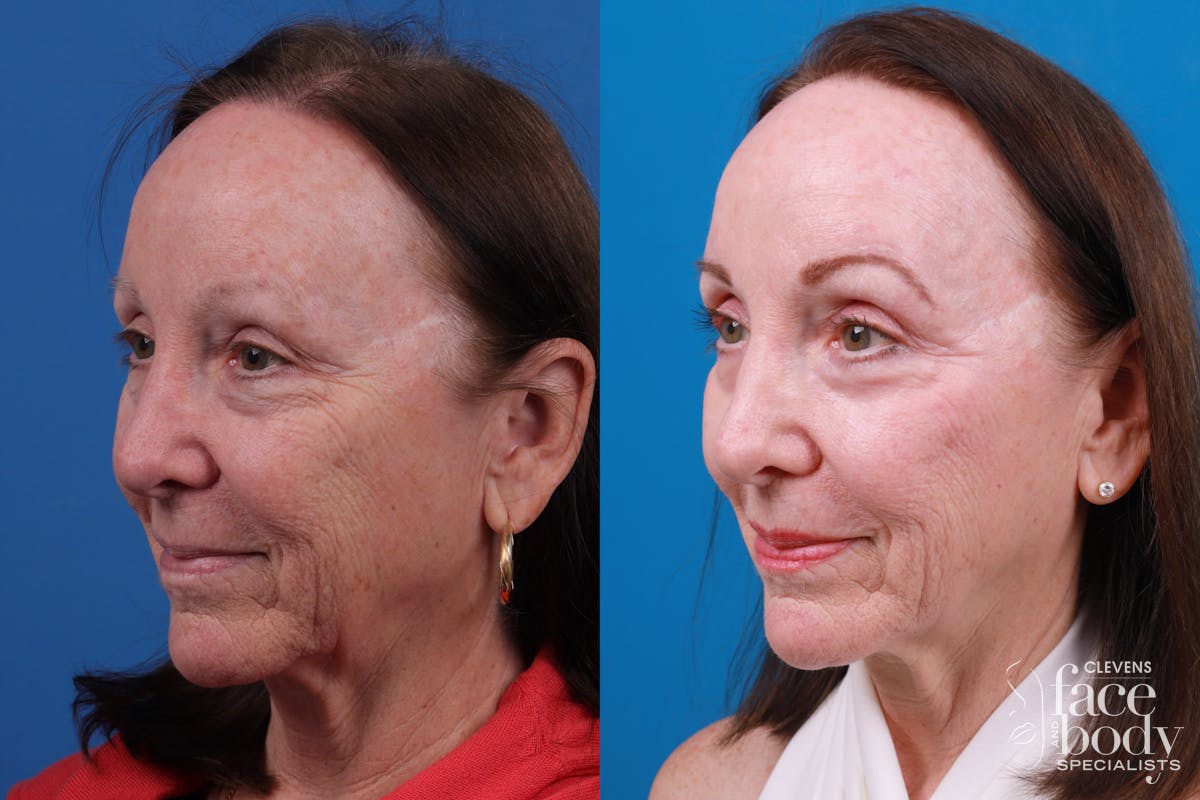 Skin Resurfacing Before & After Gallery - Patient 150490829 - Image 2