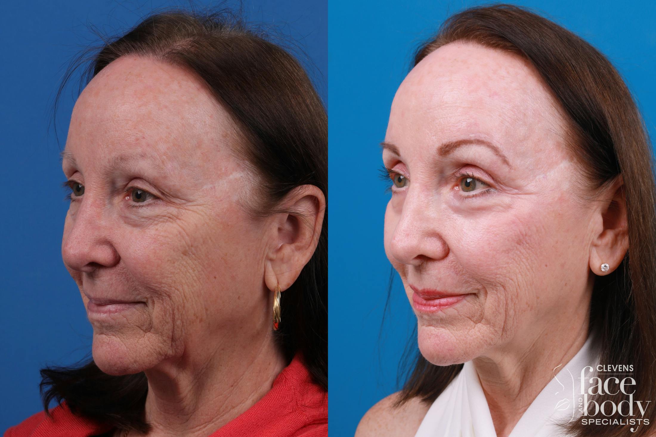 Skin Resurfacing Before & After Gallery - Patient 150490829 - Image 2