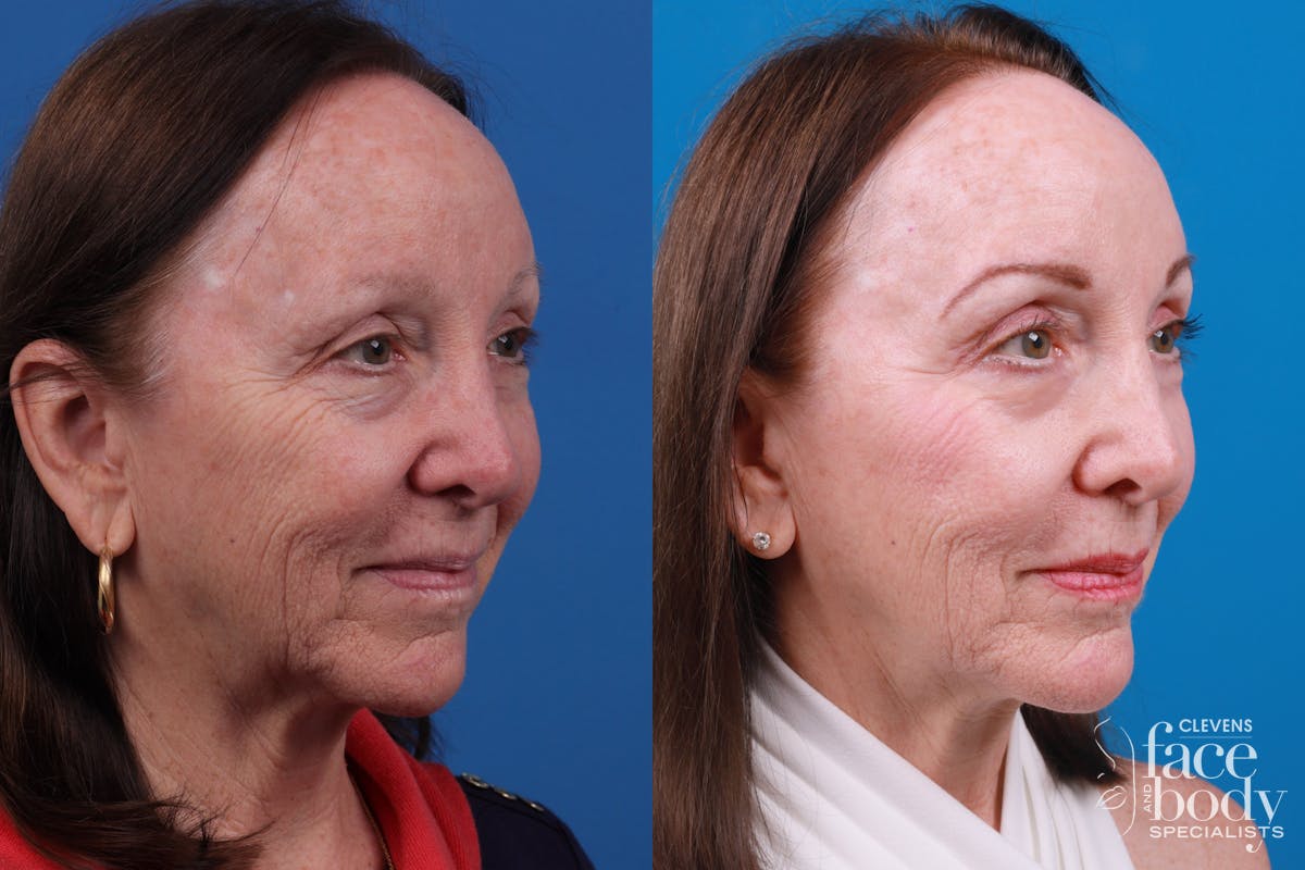 Skin Resurfacing Before & After Gallery - Patient 150490829 - Image 3