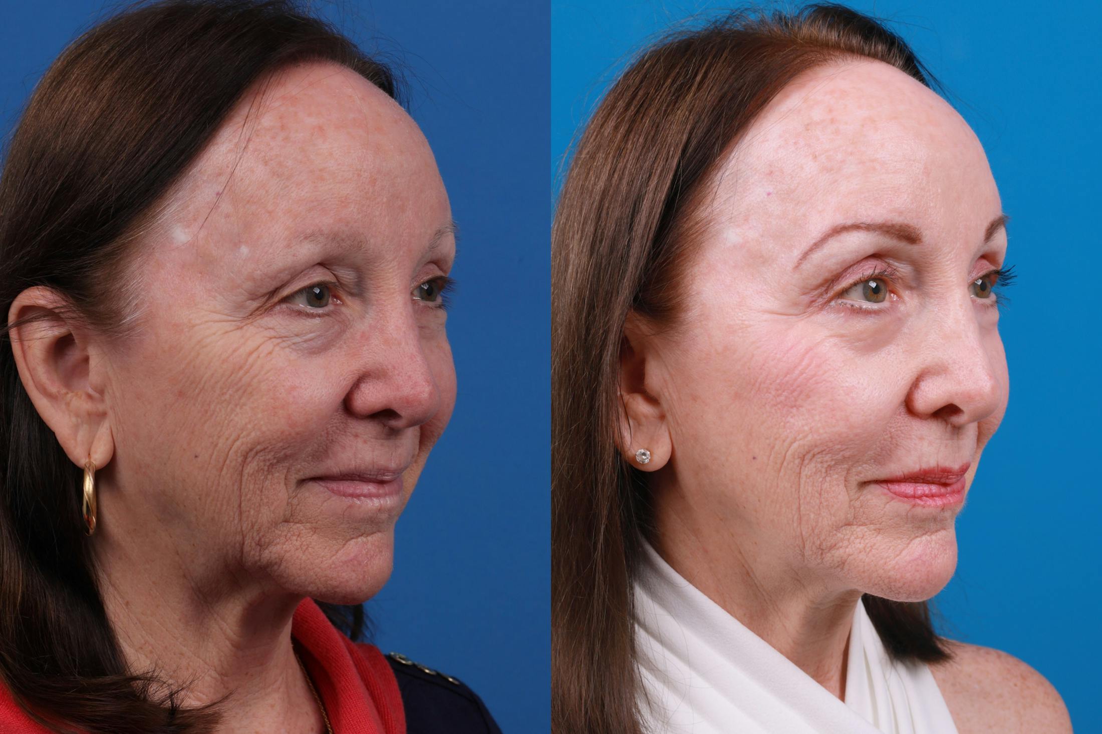 Brow Lift Before & After Gallery - Patient 150490826 - Image 3