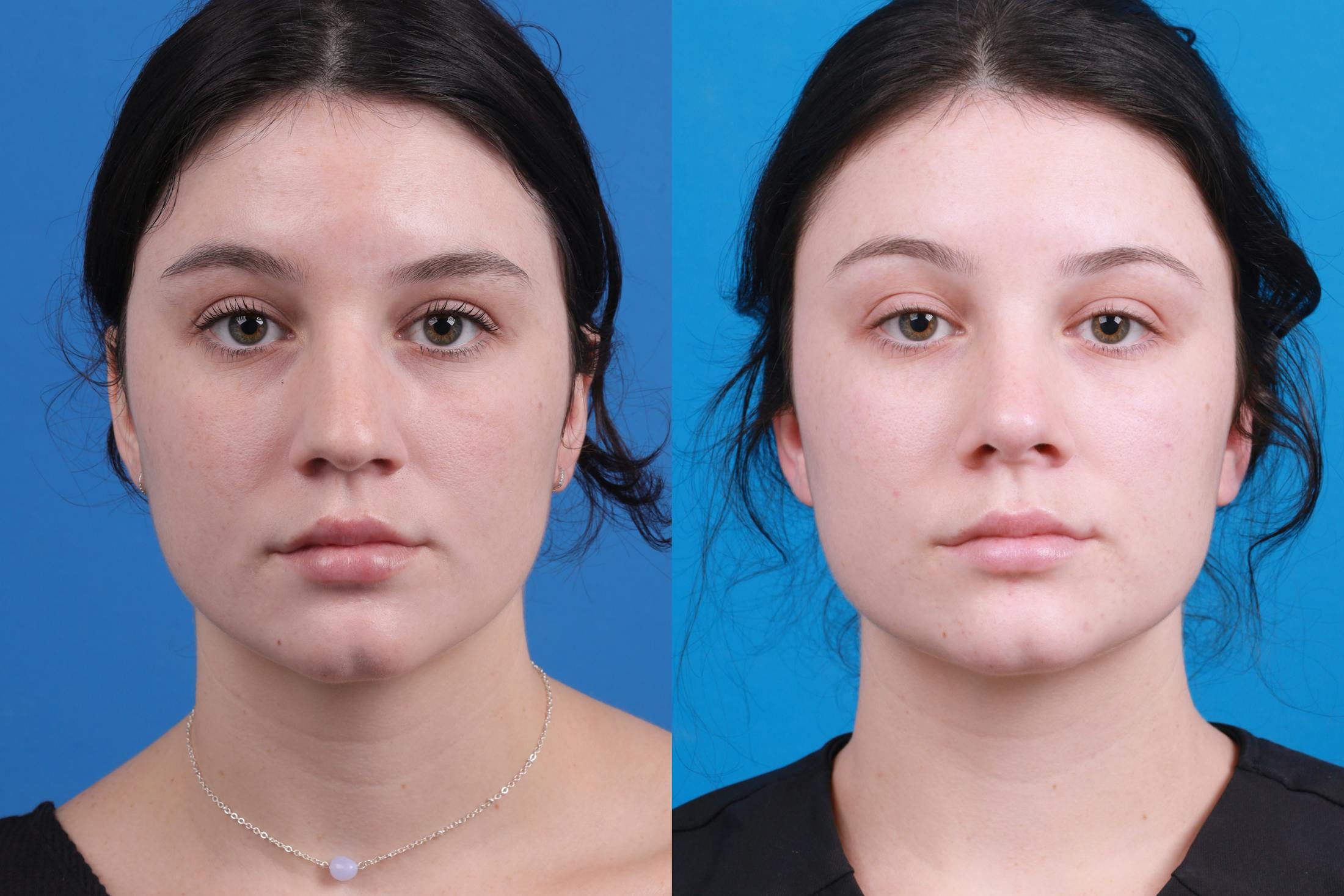 Rhinoplasty Before & After Gallery - Patient 150490831 - Image 1