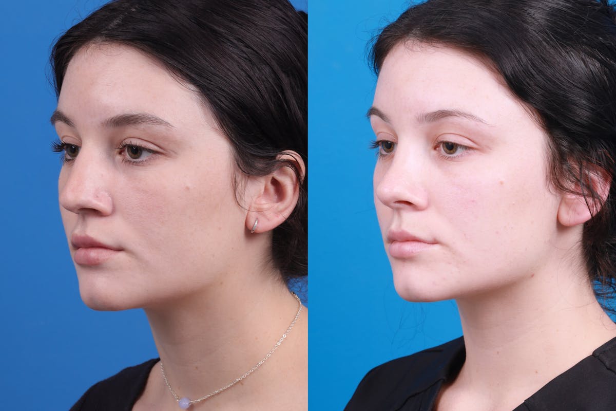 Rhinoplasty Before & After Gallery - Patient 150490831 - Image 2