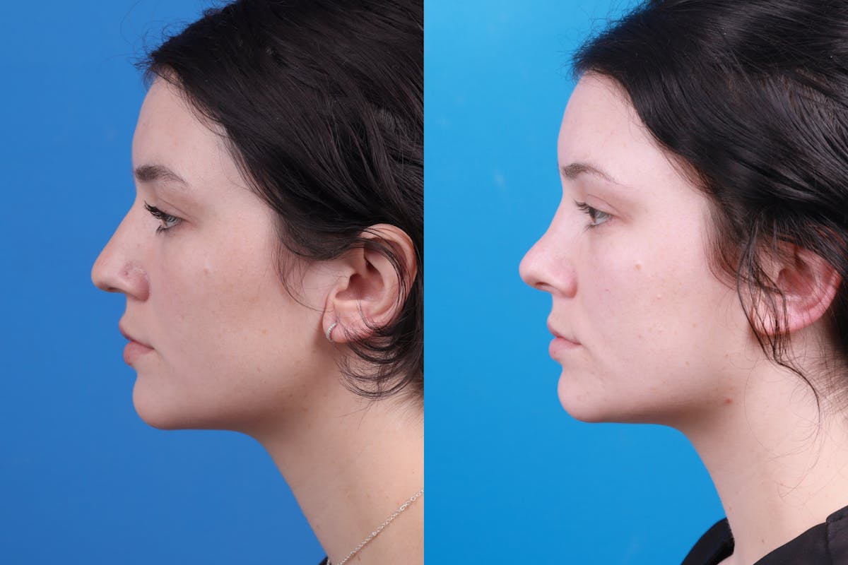 Rhinoplasty Before & After Gallery - Patient 150490831 - Image 3