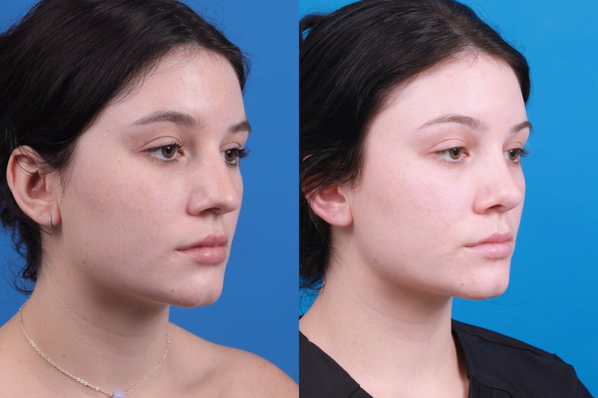 Rhinoplasty Before & After Gallery - Patient 150490831 - Image 4