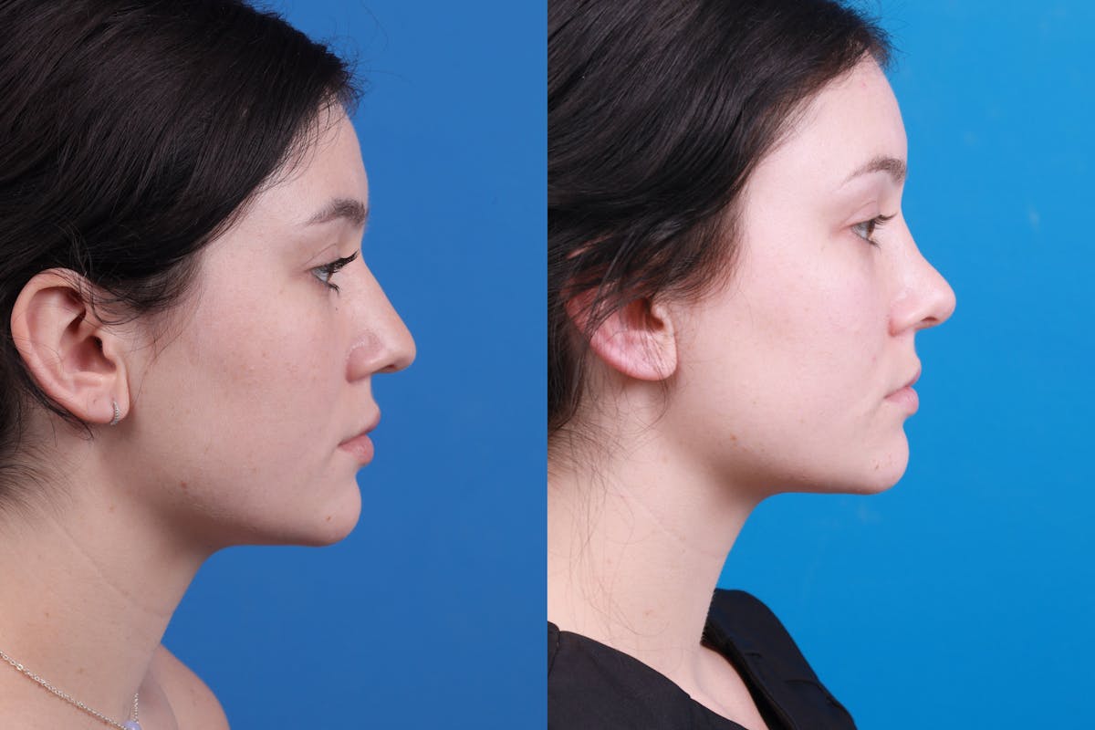 Rhinoplasty Before & After Gallery - Patient 150490831 - Image 5