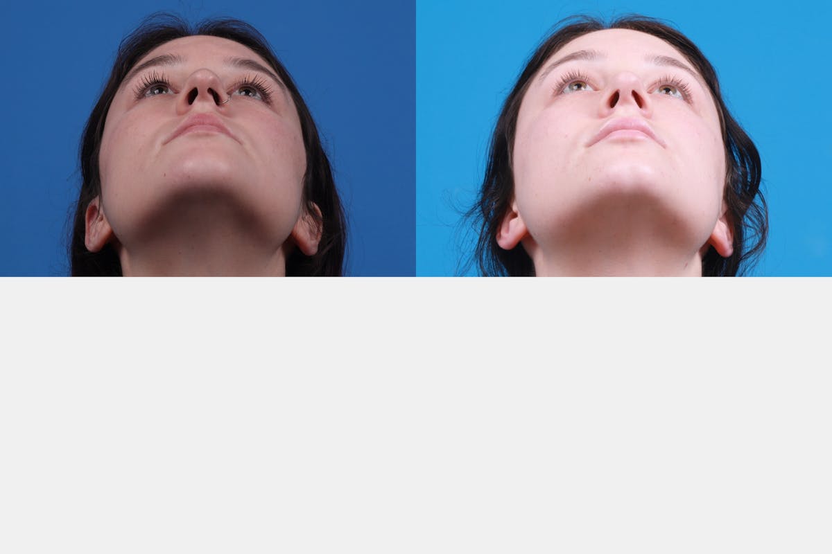 Rhinoplasty Before & After Gallery - Patient 150490831 - Image 6