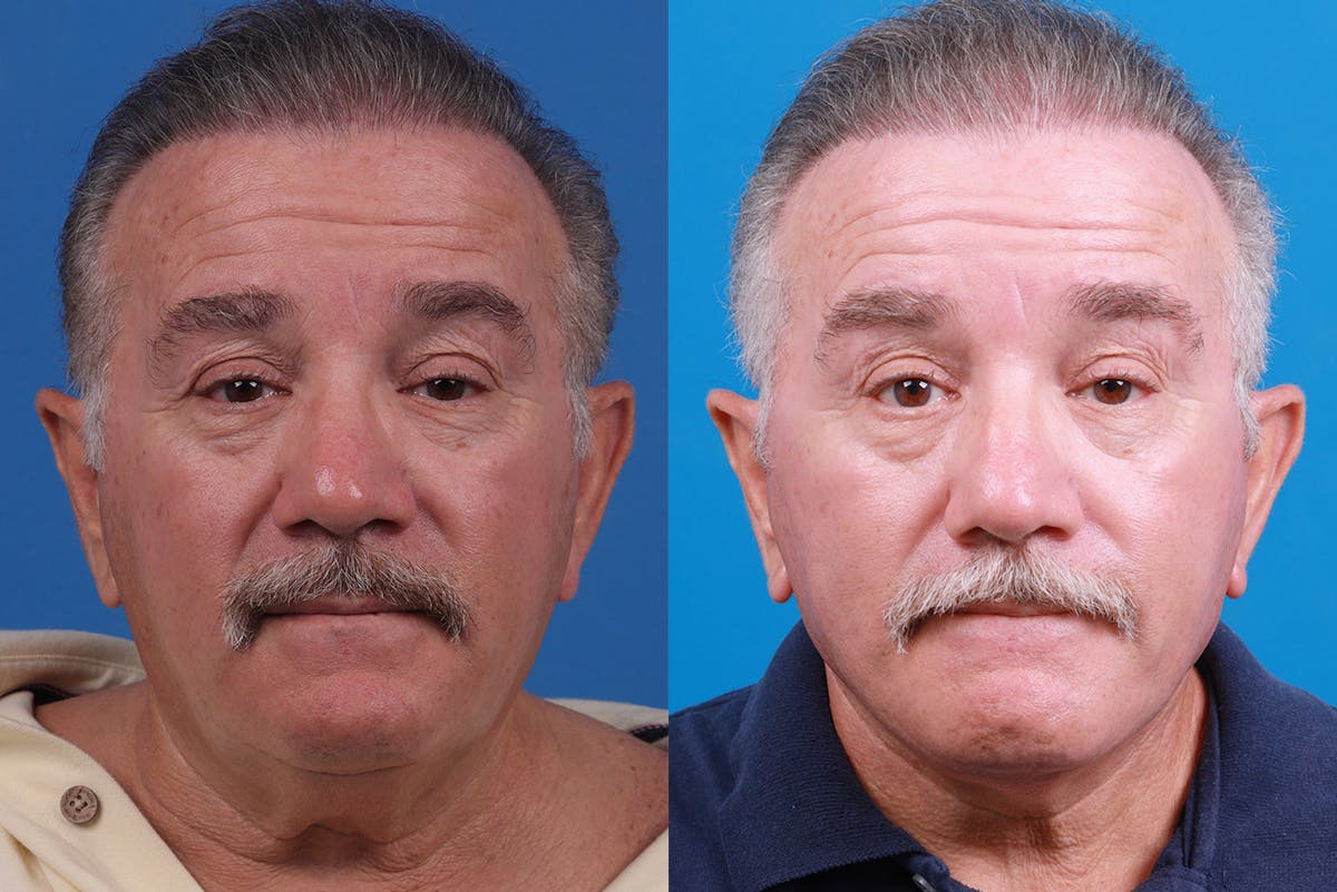 Facelift Before & After Gallery - Patient 150585031 - Image 1