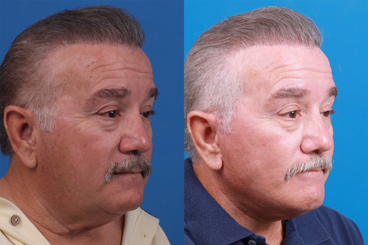 Facelift Before & After Gallery - Patient 150585031 - Image 2